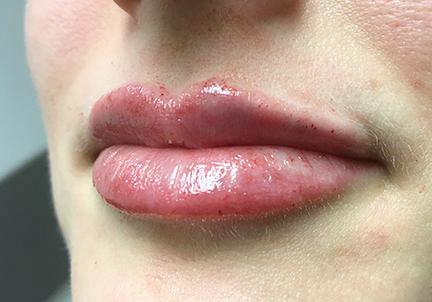 An After Photo of Lip Filler Injections by Dr. K in Seattle and Tacoma