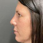 An After Photo of a Rhinoplasty Plastic Surgery by Dr. Craig Jonov in Seattle and Tacoma