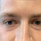 A Before Photo of Under Eye Filler by Dr. K in Seattle and Tacoma