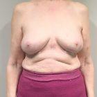 An After Photo of En Bloc Breast Implant Plastic Surgery by Dr. Craig Jonov in Seattle and Tacoma