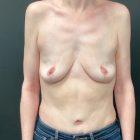 An After Photo of a Tummy Tuck Plastic Surgery by Dr. Craig Jonov in Seattle and Tacoma