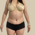 An After Photo of A Tummy Tuck Plastic Surgery by Dr. Craig Jonov in Seattle and Tacoma