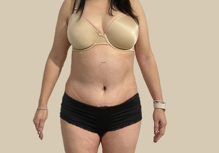 An After Photo of A Tummy Tuck Plastic Surgery by Dr. Craig Jonov in Seattle and Tacoma