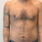 An After Photo of Gynecomastia Plastic Surgery by Dr. Craig Jonov in Seattle and Tacoma