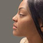 An After Photo of Cheek Filler Injections by Dr. K in Seattle and Tacoma