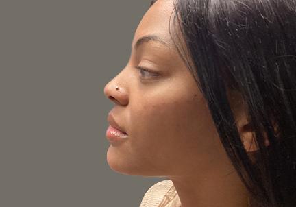 An After Photo of Cheek Filler Injections by Dr. K in Seattle and Tacoma