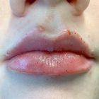 An After Photo of Restylane Kysse Lip Filler in Seattle and Tacoma