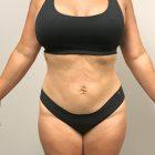 An After Photo of a Mini Tummy Tuck Plastic Surgery by Dr. Craig Jonov in Seattle and Tacoma