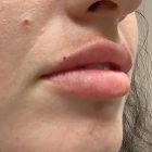 An After Photo of Restylane Kysse Lip Filler in Seattle & Tacoma