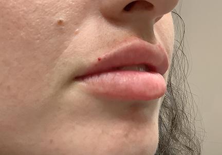 An After Photo of Restylane Kysse Lip Filler in Seattle & Tacoma