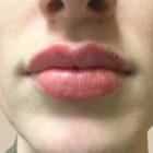 An After Photo of Restylane Kysse Lip Filler in Seattle and Tacoma