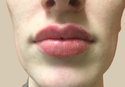 An After Photo of Restylane Kysse Lip Filler in Seattle and Tacoma