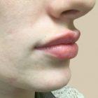 An After Photo of Restylane Kysse Lip Filler in Seattle and Tacoma