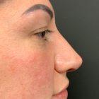 An After Photo of a Non-Surgical Rhinoplasty in Seattle and Tacoma