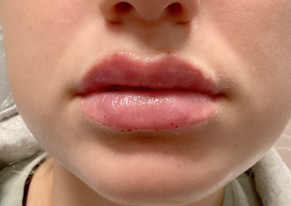 An After Photo of Restylane Kysse Lip Filler in Bellevue and Kirkland