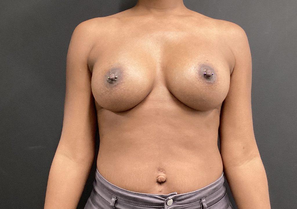 An After Photo of Breast Augmentation Plastic Surgery by Dr. Craig Jonov in Seattle and Tacoma