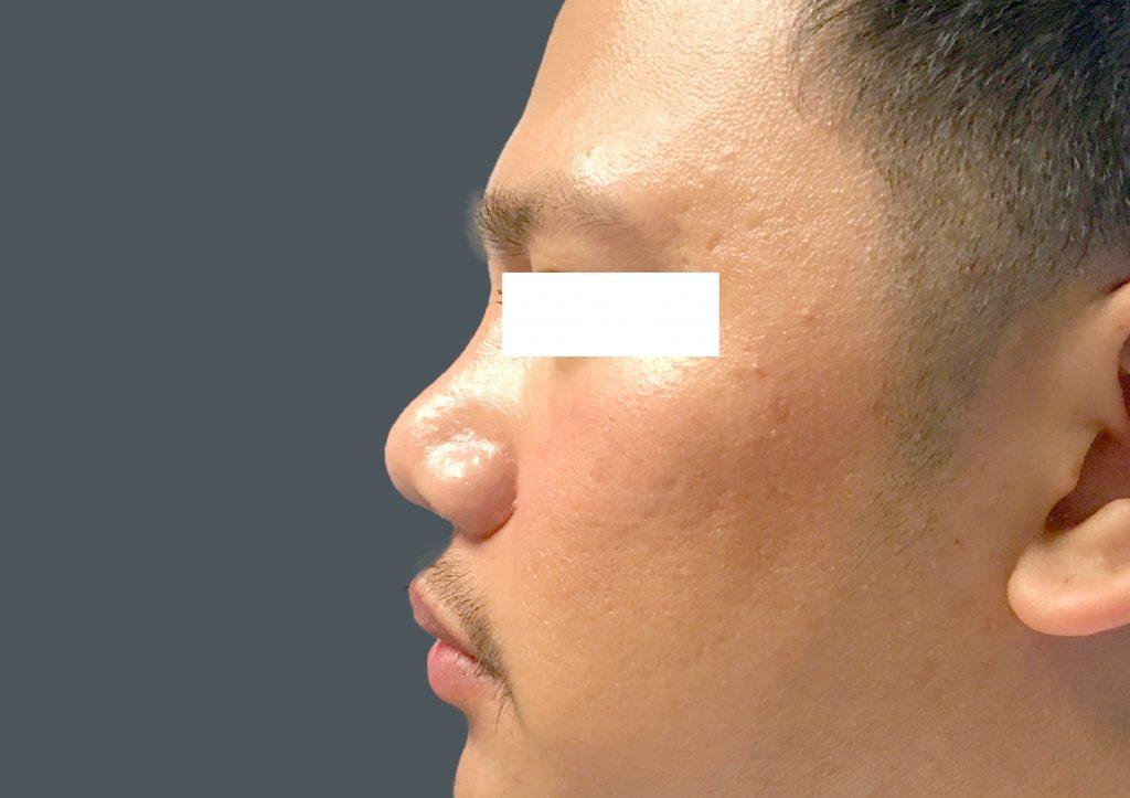 An After Photo of a Rhinoplasty Plastic Surgery by Dr. David Santos in Seattle and Tacoma