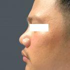 An After Photo of a Rhinoplasty Plastic Surgery by Dr. David Santos in Seattle and Tacoma