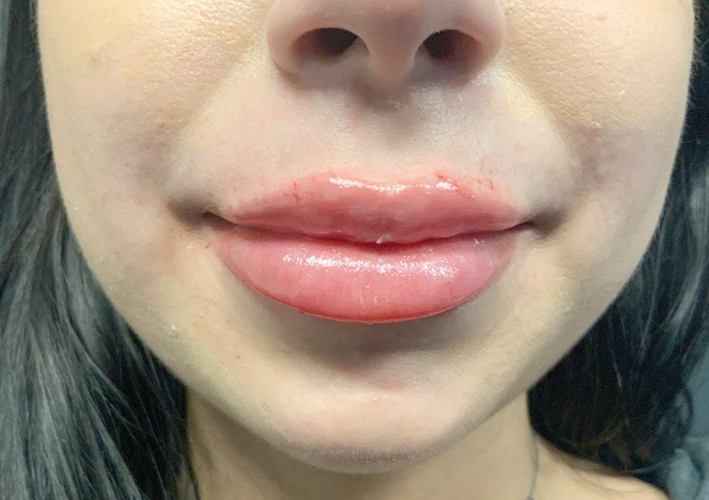 An After Photo of Lip Filler Injections in Seattle and Tacoma