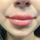 An After Photo of Lip Filler Injections in Seattle and Tacoma