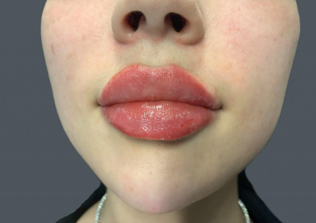 An After Photo of Restylane Kysse Lip Filler in Seattle and Tacoma
