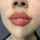 An After Photo of Restylane Kysse Lip Filler in Seattle and Tacoma