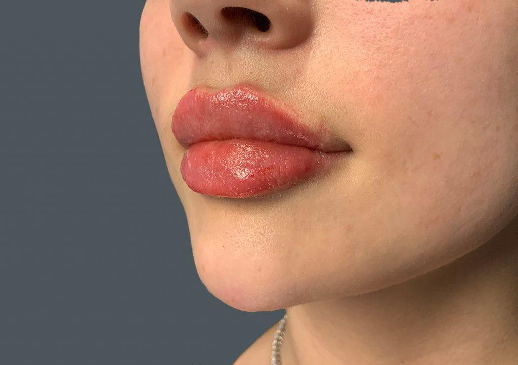 An After Photo of Restylane Kysse Lip Filler in Seattle and Tacoma