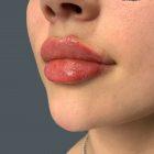 An After Photo of Restylane Kysse Lip Filler in Seattle and Tacoma