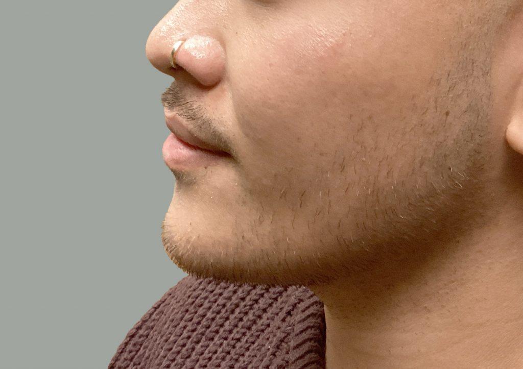 An After Photo of Chin Filler Injections in Seattle and Tacoma