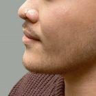 An After Photo of Chin Filler Injections in Seattle and Tacoma