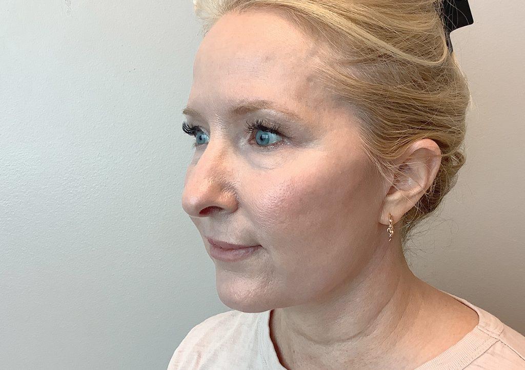 An After Photo of a Facelift Plastic Surgery by Dr. David Santos in Seattle and Tacoma