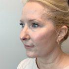 An After Photo of a Facelift Plastic Surgery by Dr. David Santos in Seattle and Tacoma