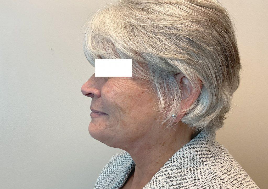 An After Photo of an Extended Facelift Plastic Surgery by Dr. David Santos in Seattle and Tacoma