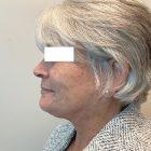 An After Photo of an Extended Facelift Plastic Surgery by Dr. David Santos in Seattle and Tacoma