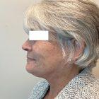 An After Photo of an Extended Facelift Plastic Surgery by Dr. David Santos in Seattle and Tacoma