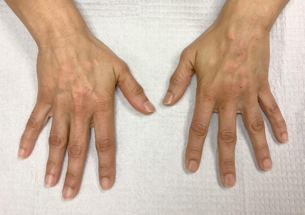 An After Photo of Hand Filler Injections in Seattle and Tacoma