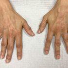 An After Photo of Hand Filler Injections in Seattle and Tacoma