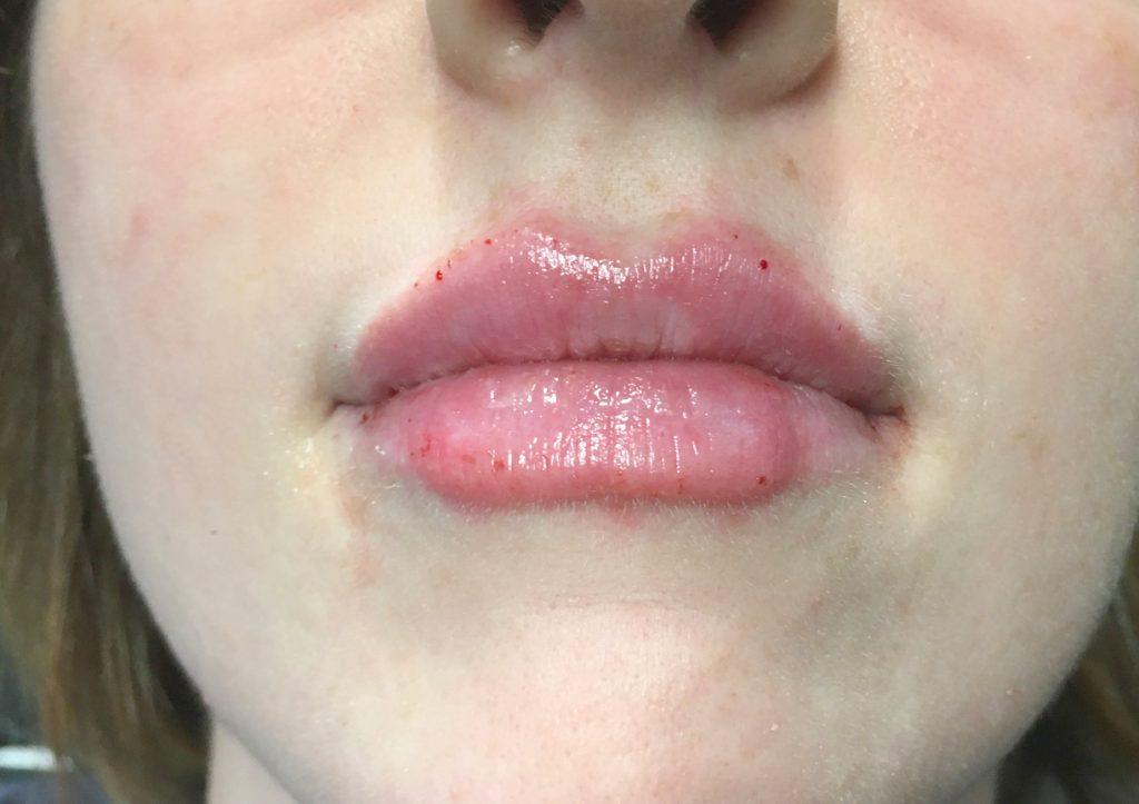 An After Photo of a Restylane Kysse Lip Filler Seattle and Tacoma