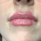 An After Photo of a Restylane Kysse Lip Filler Seattle and Tacoma