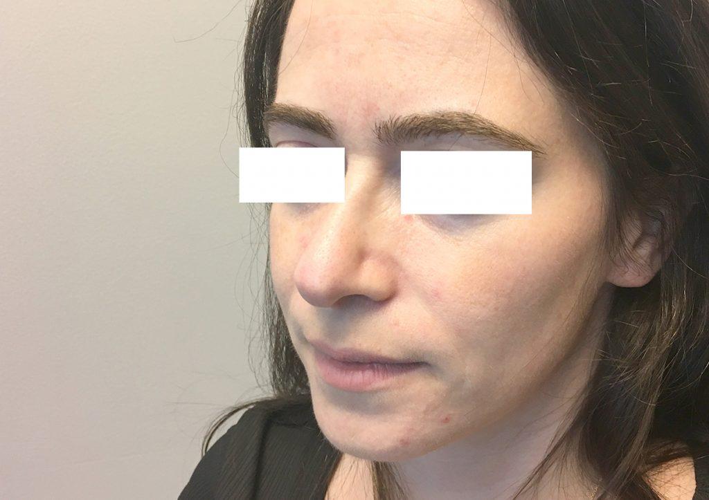 An After Photo of a Rhinoplasty Plastic Surgery by Dr. David Santos in Seattle and Tacoma