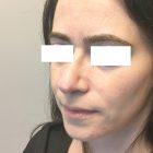 An After Photo of a Rhinoplasty Plastic Surgery by Dr. David Santos in Seattle and Tacoma