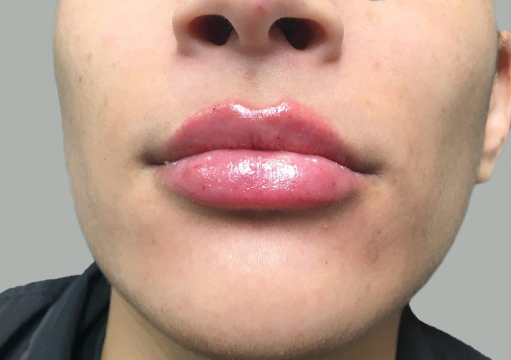 An After Photo of Restylane Kysse Lip Filler in Seattle and Tacoma