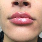 An After Photo of Restylane Kysse Lip Filler in Seattle and Tacoma