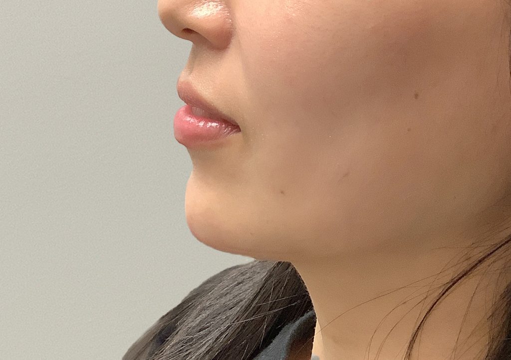 An After Photo of Chin Filler in Seattle and Tacoma