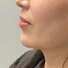 An After Photo of Chin Filler in Seattle and Tacoma