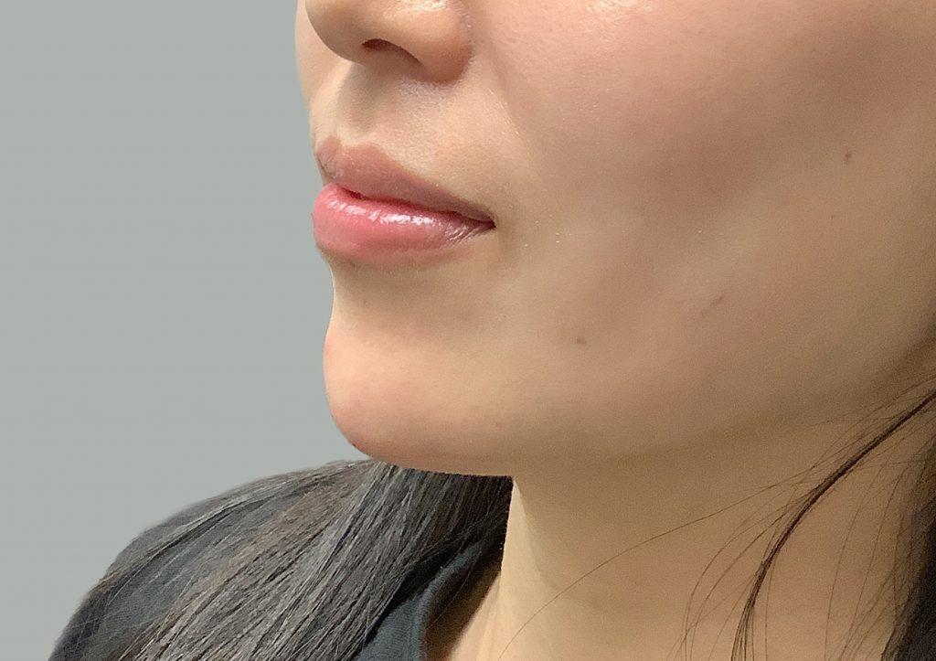 An After Photo of Chin Filler in Seattle and Tacoma