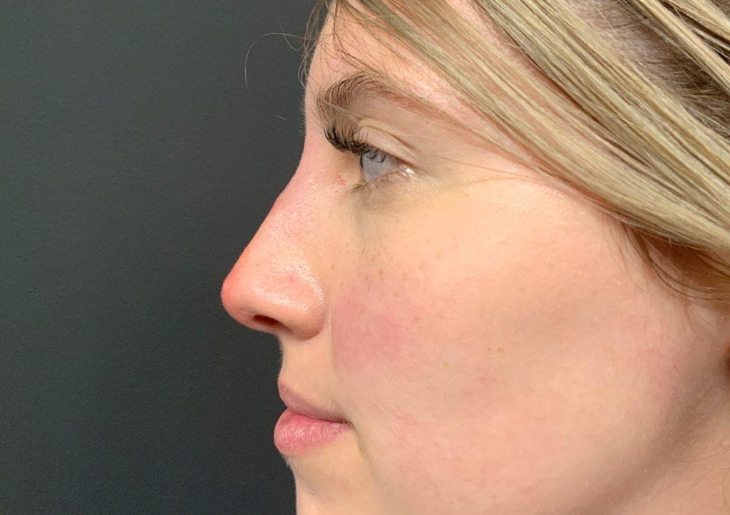 An After Photo of a Non-Surgical Rhinoplasty in Seattle and Tacoma
