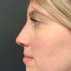 An After Photo of a Non-Surgical Rhinoplasty in Seattle and Tacoma