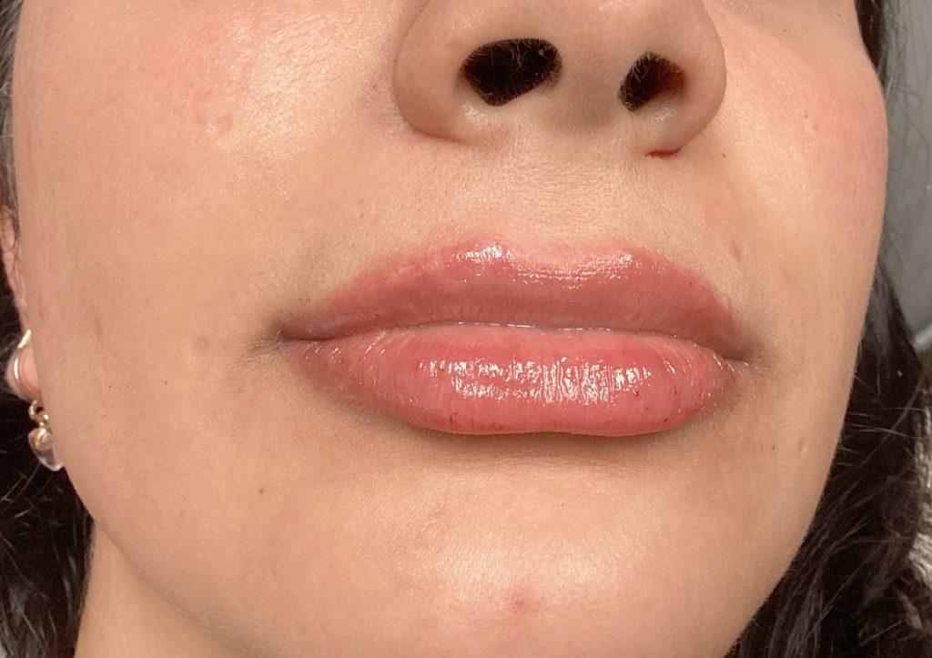An After Photo of Lip Filler Injections in Seattle and Tacoma