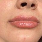 An After Photo of Lip Filler Injections in Seattle and Tacoma